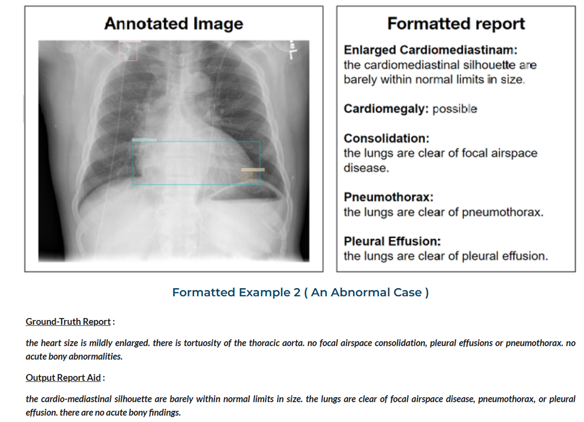 Chest X-ray Report Generation