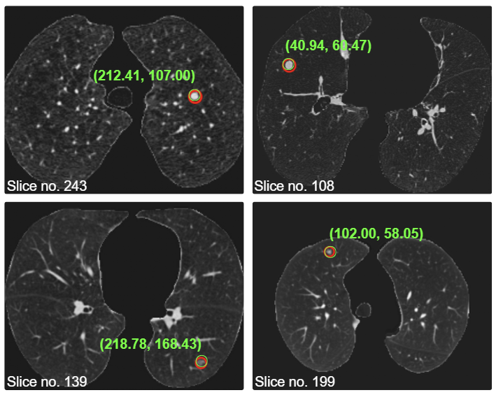 Lung Cancer Screening